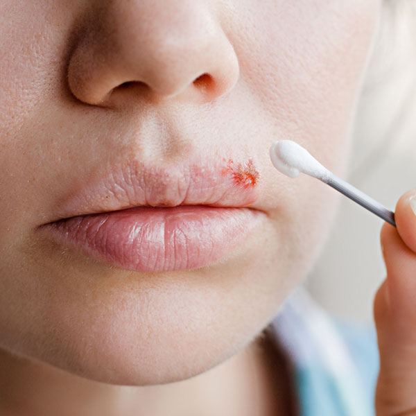 Nahaufnahme eines Mundes mit einer blutigen, aufgebrochenen Lippenherpes-Wunde, auf die gerade mit einem Wattestäbchen eine Salbe aufgetragen wird.