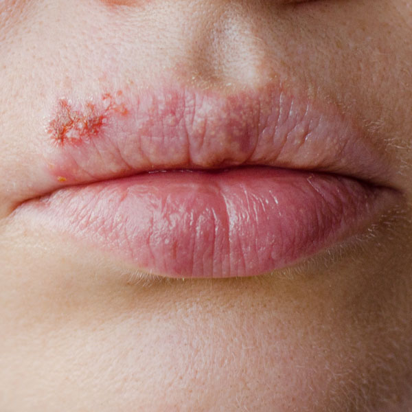 Nahaufnahme der Lippen eines Menschen, die eine deutliche, krustige Lippenherpes-Läsion (Herpes labialis) auf der Oberlippe zeigen.